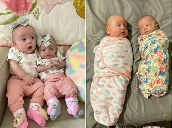 ولادة طفلة صغيرة أصغر بثلاث مرات من شقيقتها التوأم