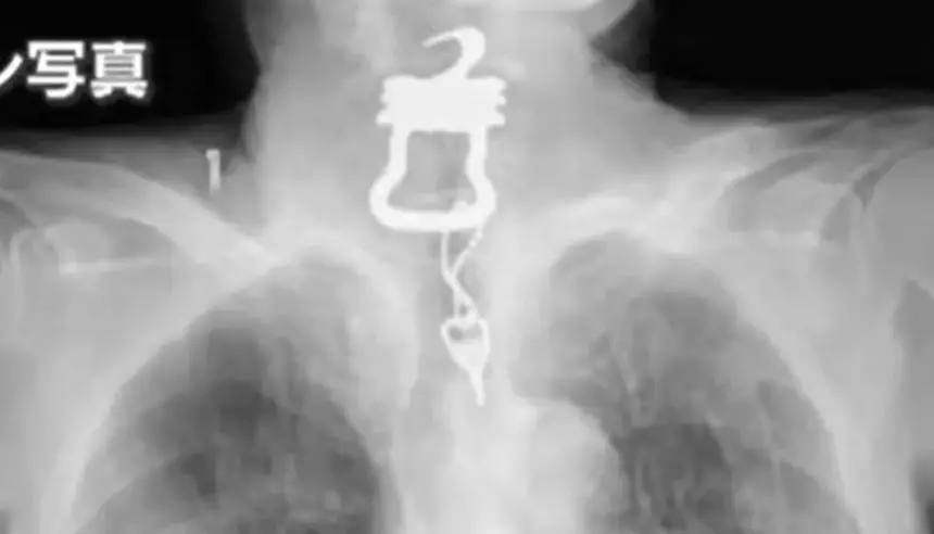 اليابان.. جدل واسع بعد وفاة مسن ابتلع مفتاحاً يستخدم لتقييد مرضى الخرف