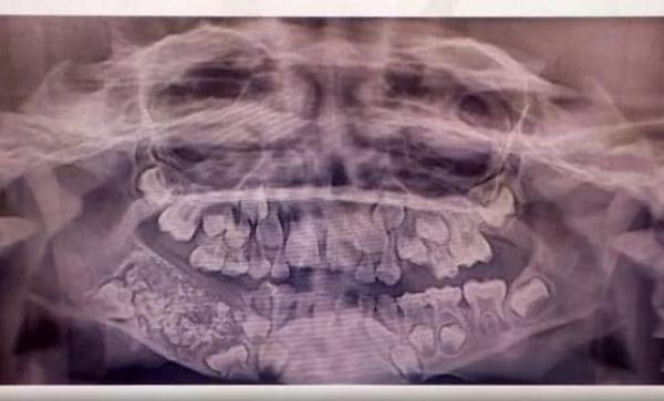 أطباء في الهند يقتلعون 526 سنا وضرسا من فم طفل