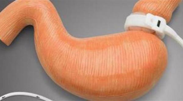 عملية تصغير المعدة.. فوائدها ومخاطرها