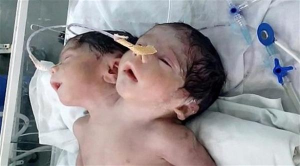 بالفيديو: طفل يولد برأسين في الهند