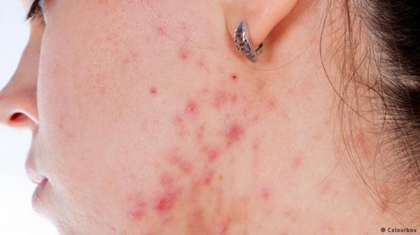 هذه الأغذية الصحية قد تتسبب في تزايد حب الشباب