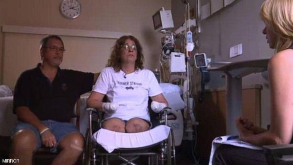 حذاري من لعاب الكلاب.. بتر الأطراف الأربعة لامرأة محبة لهذه الحيوانات