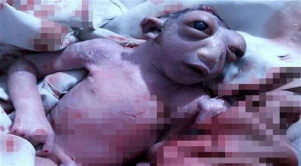 طفلة تولد بنصف رأس تذهل الأطباء