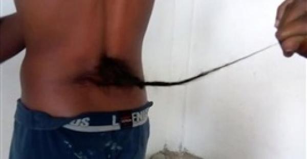 حالة نادرة لنمو ذيل في ظهر مراهق هندي (فيديو)