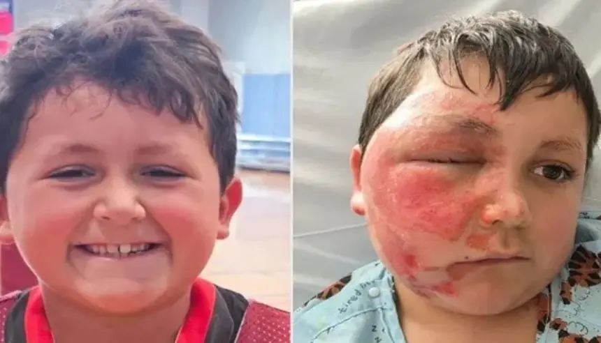 تحدٍ متداول على تيك توك يتسبب في إصابة طفل بحروق خطيرة