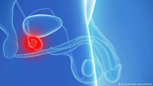 لمن تجاوز الـ40 من الرجال.. اذهب لفحص سرطان البروستاتا!