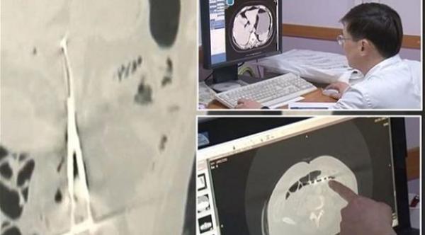  أطباء يتركون مقصاً داخل بطن مريض 12 عاماً (ميرور البريطانية) 