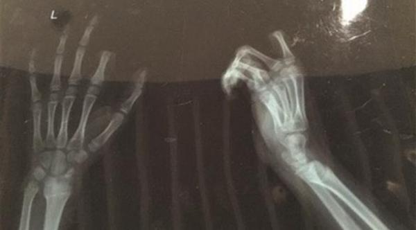 فتى صيني يبتر إصبع يده بعد اتهامه بأنه مدمن على هاتفه الذكي