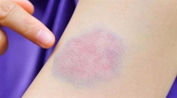 متى يتوجب القلق من ظهور بقع زرقاء في الجسم؟