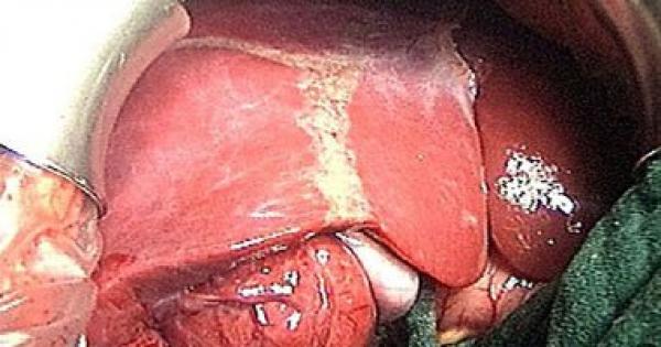 تطويرعلاج جديد لفيرس "سى"