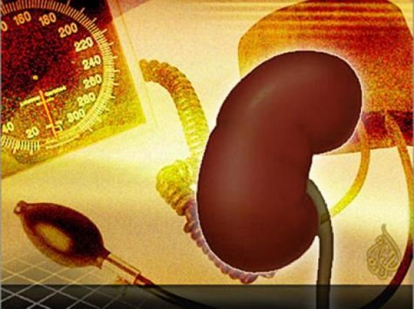 قليل من الرياضة يقي من حصى الكلى