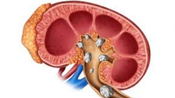 مشروب طبيعي لتفتيت حصوات الكلى