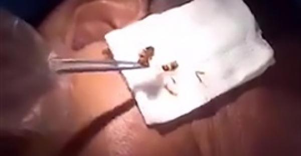 طبيب يزيل صرصارا حيا من أذن رجل (فيديو)