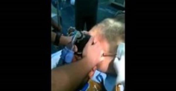 بالفيديو : أطباء يزيلون "سيخ حديد" من رقبة مريض