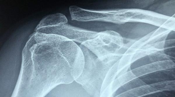 المصابون بهشاشة العظام  أكثر عرضة لخطر حصوات الكلى