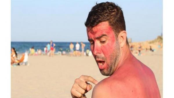 طبيب يقدم 7 نصائح مهمة لتجنب الحروق وأضرار البشرة على الشاطئ