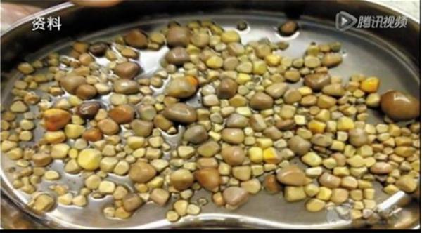 إزالة 420 حصوة من كلى رجل صيني