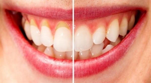 دراسة تربط بين أمراض اللثة وسرطان الكبد