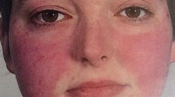 احمرار الوجه المستمر .. علام يدل؟