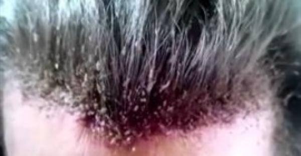 بالفيديو.. لقطات مروعة لرأس شاب تحول إلى مزرعة لـ«القمل»