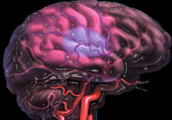 مواد غذائية تنظف الشرايين وتقي من السكتة الدماغية