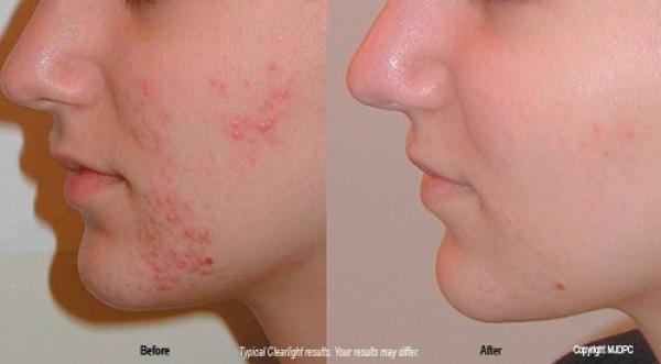 طريقة لإزالة أثار حب الشباب