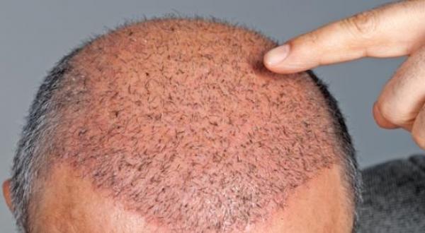 حيرة في وسط عالم التجميل بعد وفاة شخص في عملية زراعة شعر