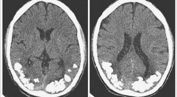 أحجار كلسية في دماغ رجل منذ 10 سنوات