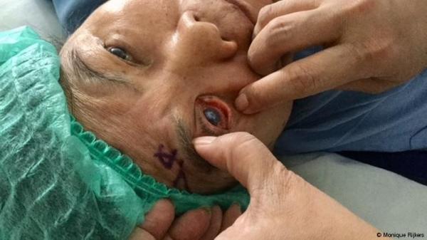 إخراج دودة خطرة طولها 15 سنتمترا من عين رجل