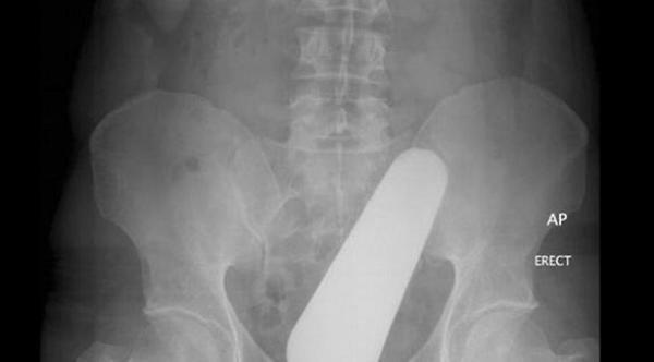 بالصور: أغرب ما رصدته أشعة "إكس راي" داخل بطون مرضى