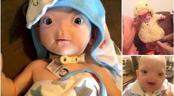 بالصور: طفل ولد بلا أنف يتحول إلى نجم على الفيس بوك