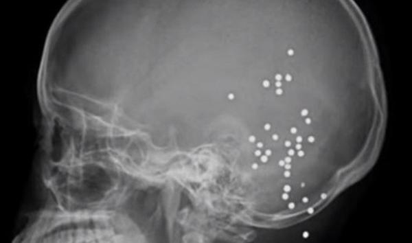 بالفيديو .. صينية تنجو من الموت رغم إصابتها بـ36 رصاصة في الرأس