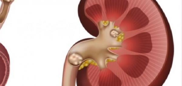 هذه أسباب تكون الحصى في الكلى