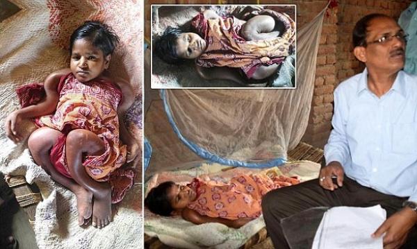 هشاشة العظام تحول عشرينية إلى "طفلة رضيعة"