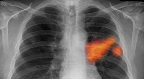 دراسة: سرطان الرئة قد يظل كامناً لمدة 20 عاماً