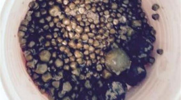 كل هذا الحصى كان في "مرارة" مريضة