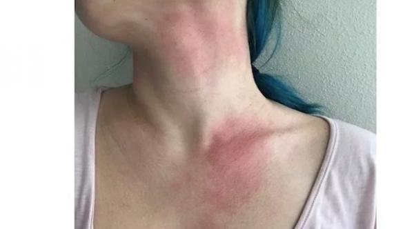 حالة صحية غريبة تمنع شابة من ذرف الدموع