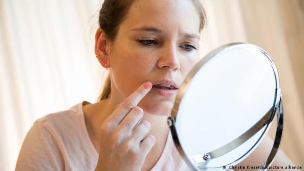 هربس الشفاه عدوى تسبب قروحا مؤلمة.. فهل من علاج؟