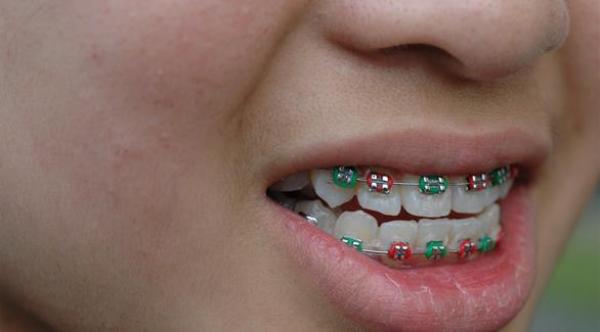 ما تحتاج معرفته عن دعامة أسنان الأطفال