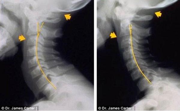 بالصور: هذا ما يحدث لك حين تكثر من استخدام الموبايل