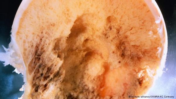 هشاشة العظام مرض خطير.. أسبابه وعلاجه