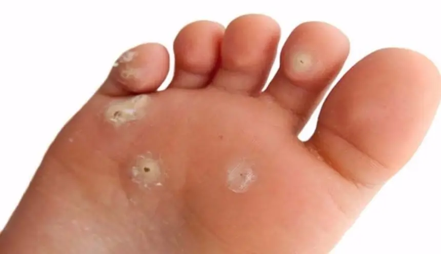 "مسمار الكيف".. حيل مجربة للوقاية منه وعلاجه