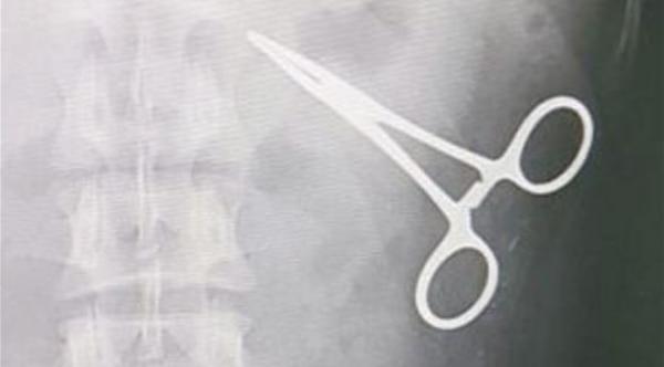 آلة كشف المعادن تعثر على مقص في بطن حاج