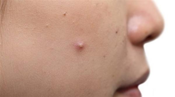 طرق علاج الرؤوس البيضاء