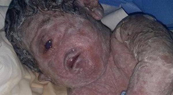 صورة: ولادة نادرة لطفل في مصر بعين واحدة ودون أنف