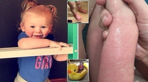 حالة صحية نادرة تمنع طفلة من البكاء والاستحمام