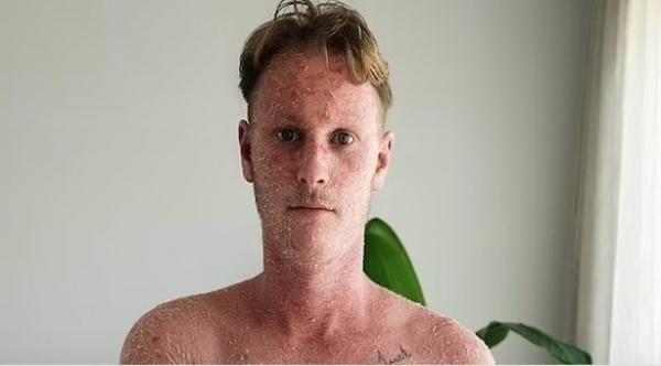 شاب أسترالي يتمكن من التعافي من الأكزيما باستخدام علاج طبيعي ياباني غير معروف