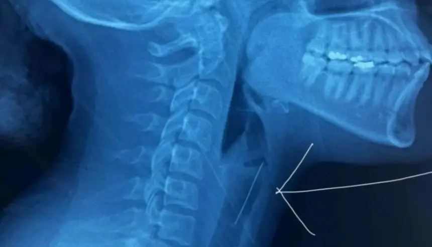 عادة شائعة كادت تودي بحياتها... شابة تنجو بأعجوبة بعد ابتلاع "دبوس حجاب" في الدار البيضاء