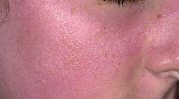 ما هي  إجراءات التي يجب إتخاذها عند الإصابة بحروق شمسية ؟